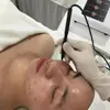 Portable Korea Technology Acacia Acne Treatment Device Professional Acne Removal Machine Shrink Pores Remove Blackhead Skin Care 6