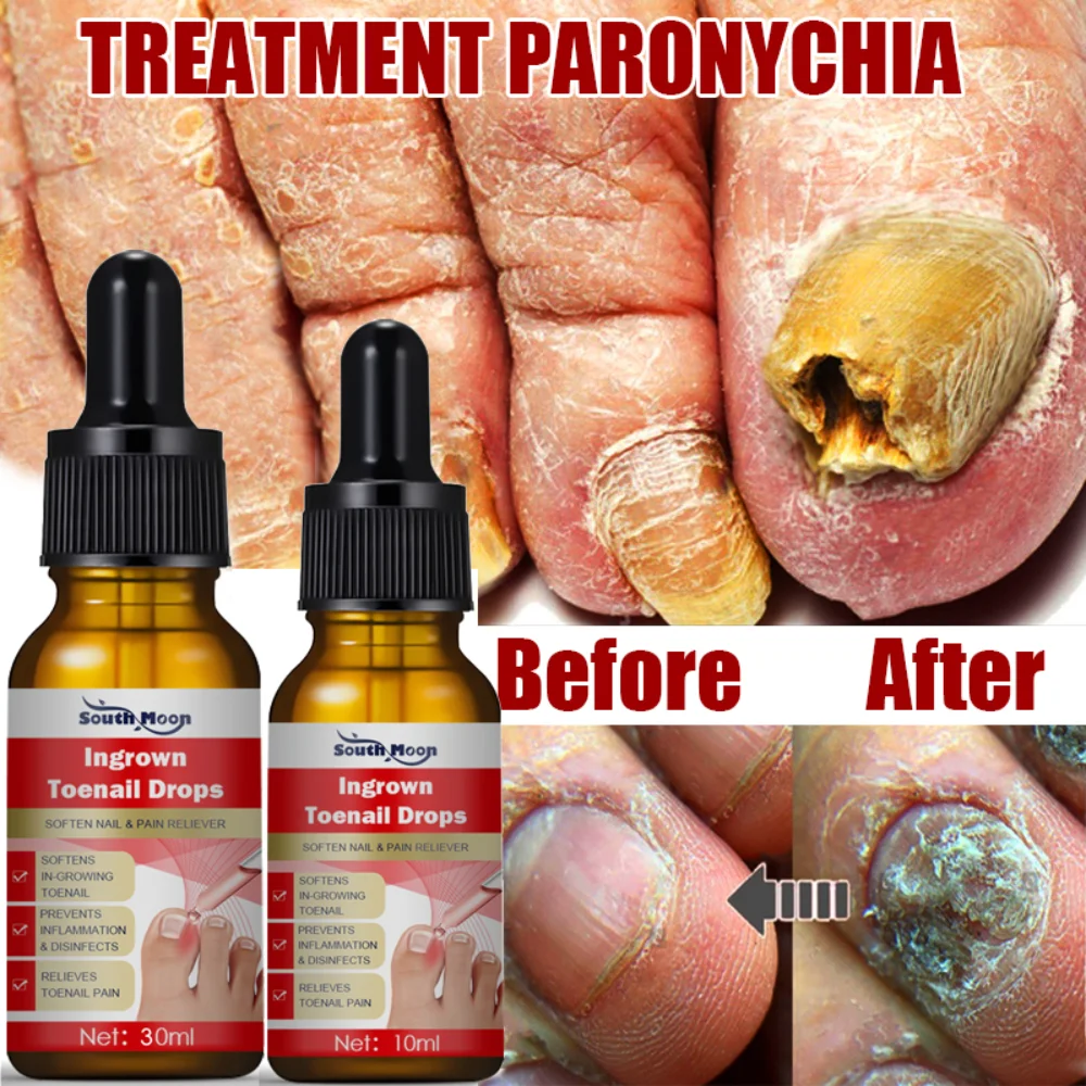 

Nail Fungal Treatment Feet Care Essence Anti Infection Paronychia Onychomycosis Prevent Ingrown Toe Nails Fungus Repair Gel 30ml