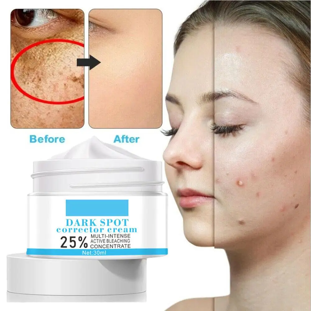 

Effective Whitening Freckles Cream Remove Melasma Dark Acne Skin Brightens Marks Spot Lightening Skin Tone Face Car W1H5