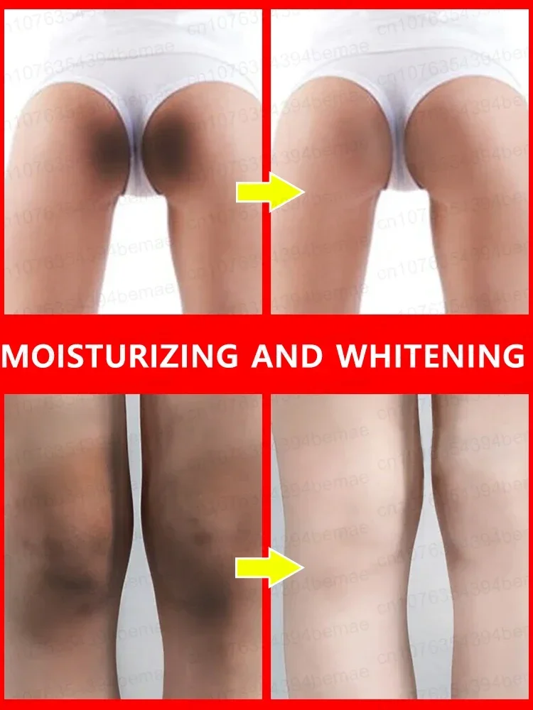 Whitening Cream Private Parts Underarm Bleaching Serum Whiten Butt Knee Brighten Inner Thigh Intimate Parts Dark Remove Melanin