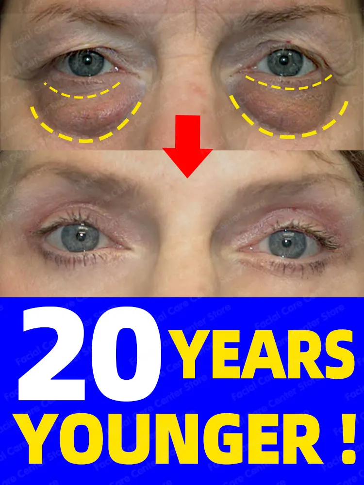 

Dark circles cream and eye bag anti bags in the eyes circle remover