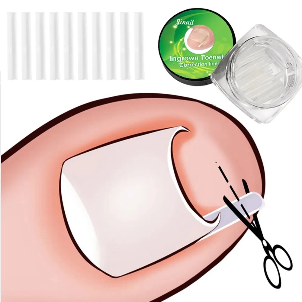  5/10Pcs Toenail Straightening Clip Ingrown Toenail Correction Tool set Nail Treatment Elastic Stickers Pedicure Foot Care Tools 