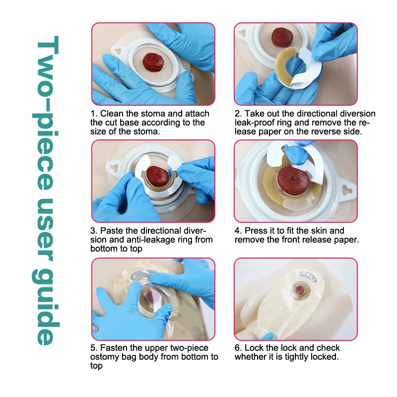 Anti-Leakage Ring For Colostomy Bag Ostomy Paste Ring Base Plates Stoma Care Products To Protect Skin