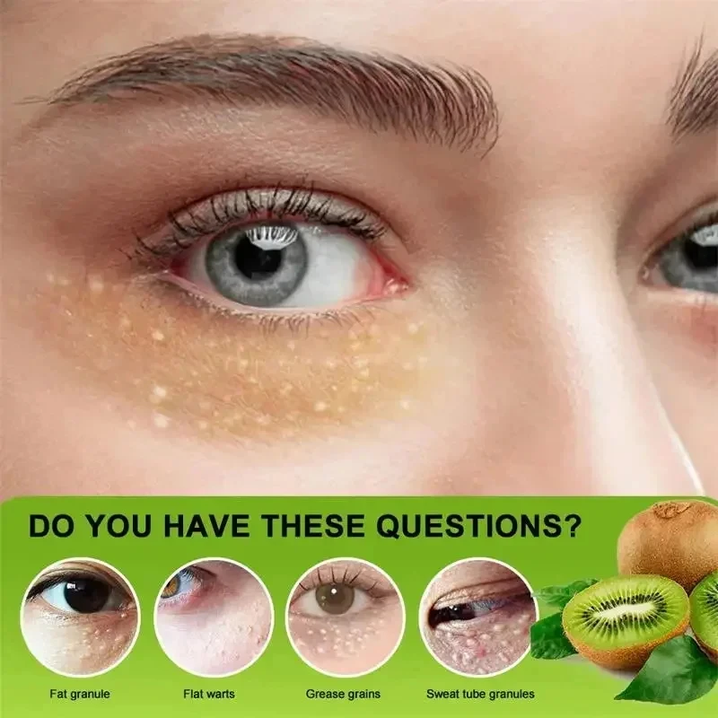 Eye Cream for Fat Granules Puffiness - Milia Remover Skin Repair