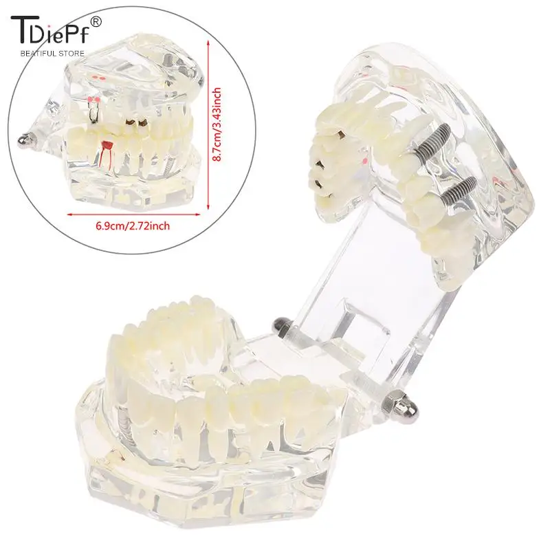 

Мост для реставрации зубных имплантов, Стоматологическая модель, обучение для изучения науки зубов