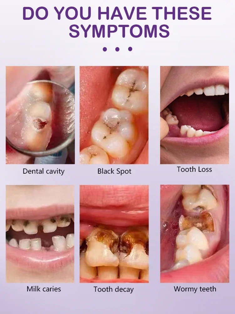 Teeth Health Product Anti Decay Toothpaste Dental Caries Repair Cream Prevent Tooth Decay Protect Teeth 30g