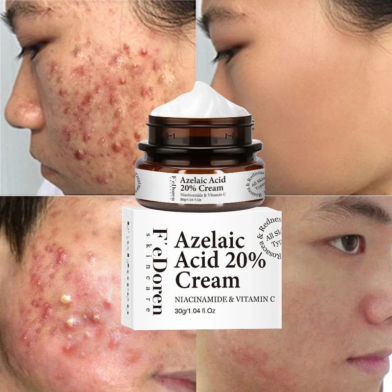 Azelaic Acid Acne Treatments Face Cream Repair Fade Scars Skin Care Ni