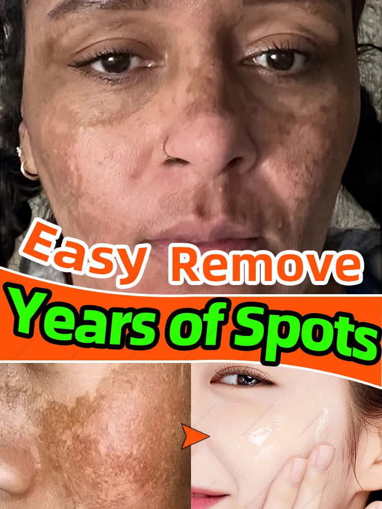 Solves all Freckles Problem