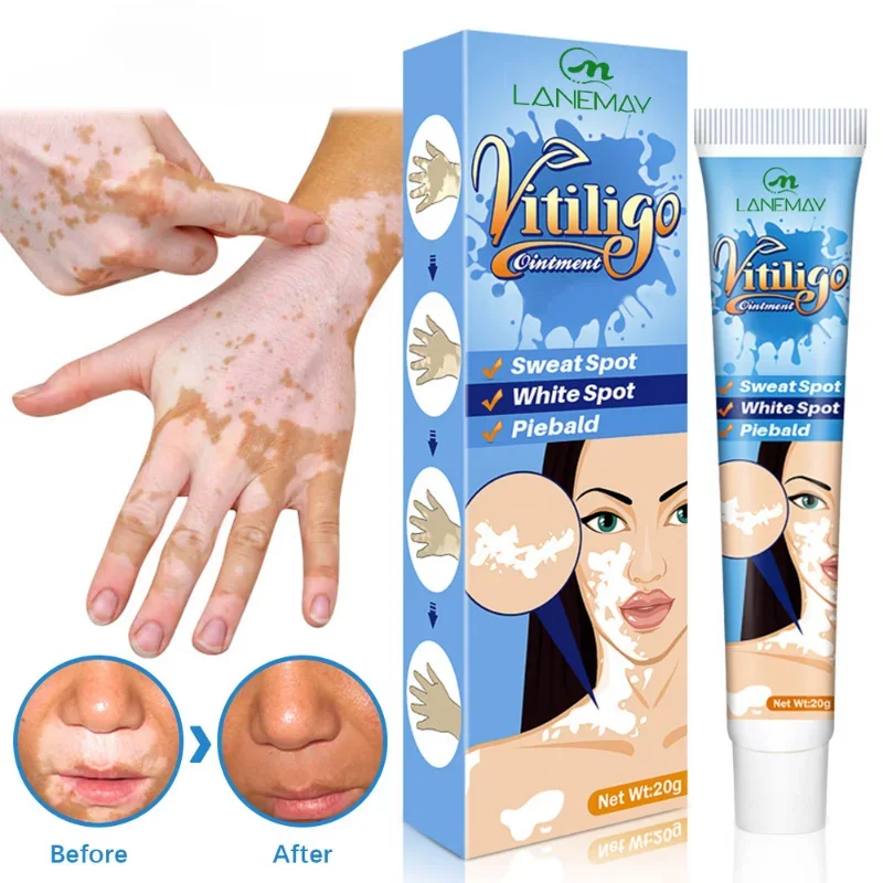 

20g Herbal Extract Vitiligo Ointment Remove Ringworm White Spot Removal Skin White Spot Leukoplakia Disease Treatment Care Cream