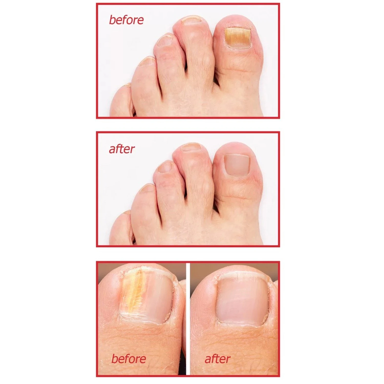 Ingrown Toenail Correction Patch Waterproof Nail Repair Tool Set_voghion.com