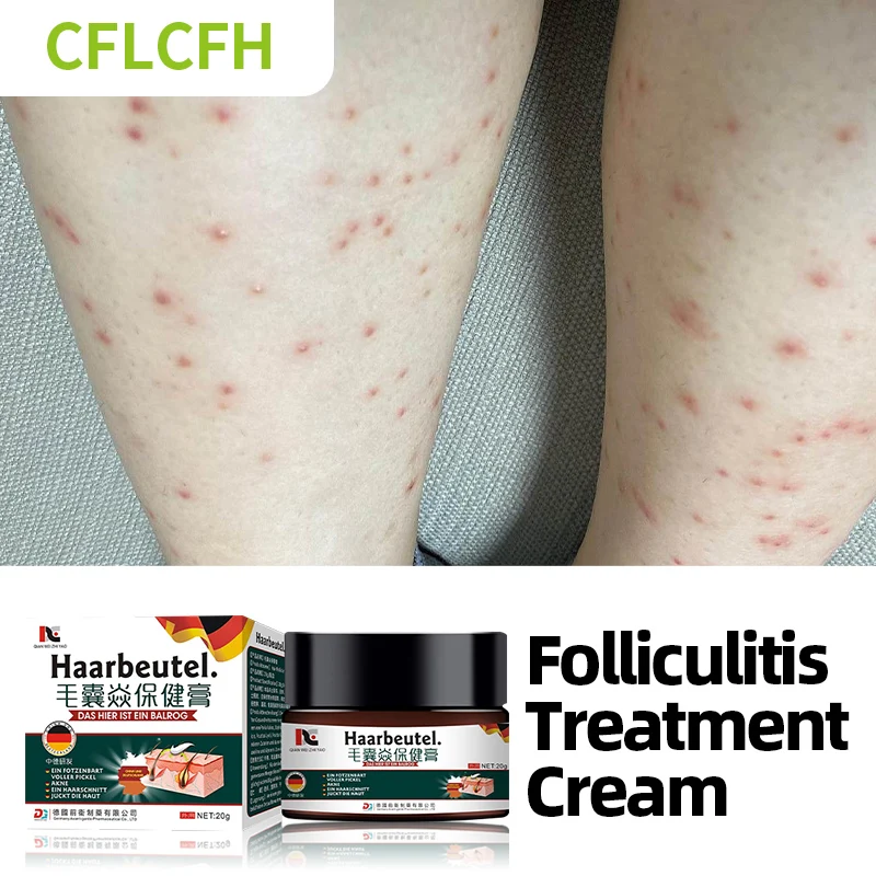 

Folliculitis Treatment Ointment Hair Scalp Remover Psoriasis Eczema Dermatitis Cream Antibacterial Anti-Itching Germany Medicine