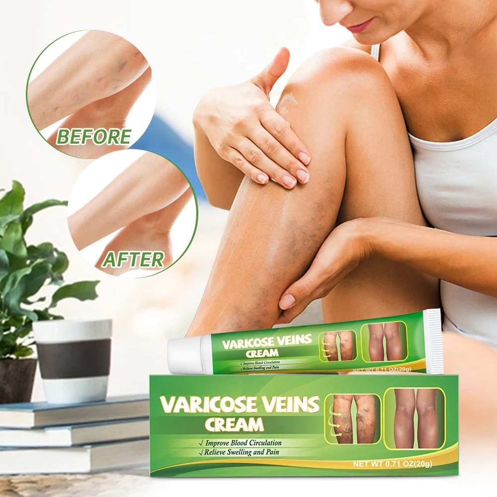 Varicose Veins Laser Treatment Cream Effective Relieve Legs Dilated Vasculitis Phlebitis Natural Formula Ointment Varicose Veins