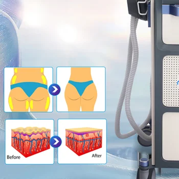 EMS Body Sculpting Device 1
