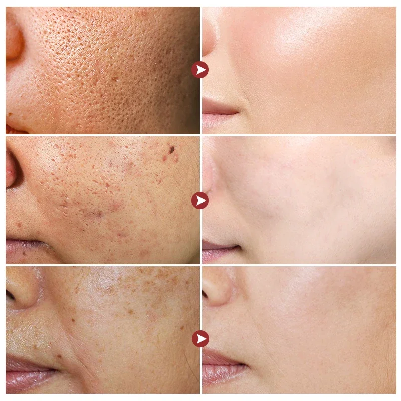 Salicylic Acid Pore Shrinking Serum Oil Control Moisturize Nourish Essence Anti Aging Smooth Pores Brighten Whitening Skin Care