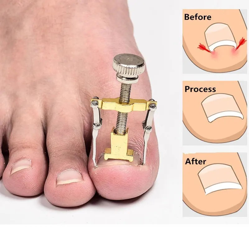 Correction of Paronychia with Toe Nail Correction Bracket for Treatment of Toe and Toe Care with Toe Fixator 4
