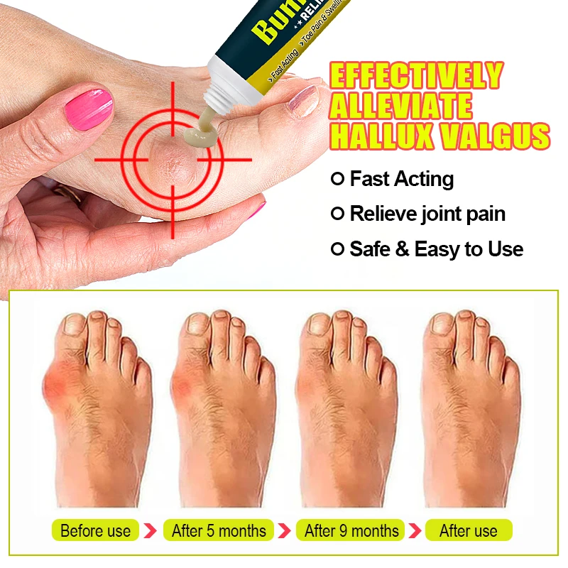 1Pcs Foot Gout Cream Arthritis Bone Thumb Corrector Finger Hallux Toe Bunion Joint Pain Relief Herbal Medical Care Ointment G049 knee pain relief cream pain relief cream skin care ointment