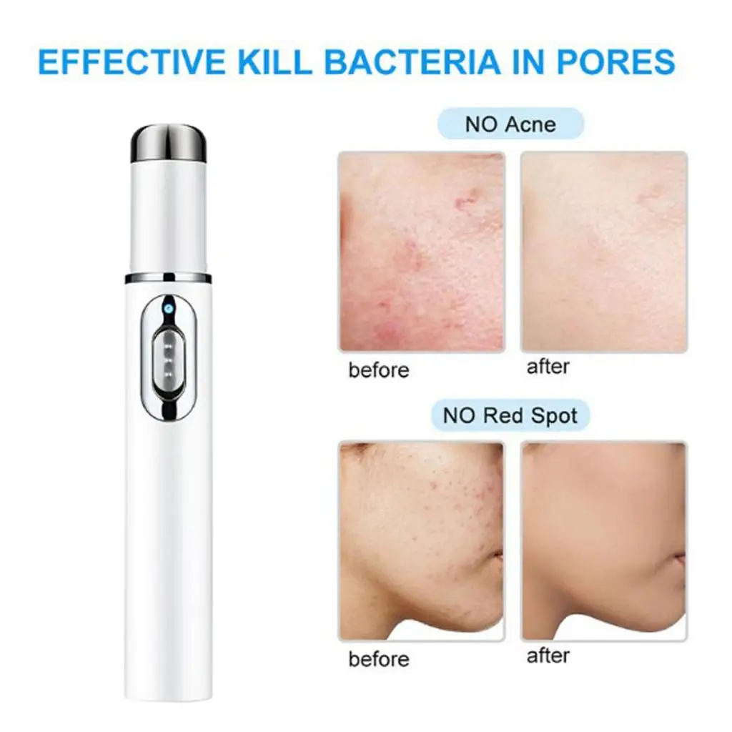 Acne Remover Blackhead Remover Blue Light Therapy Pen for Soft Scar Wrinkle Removal and Relax