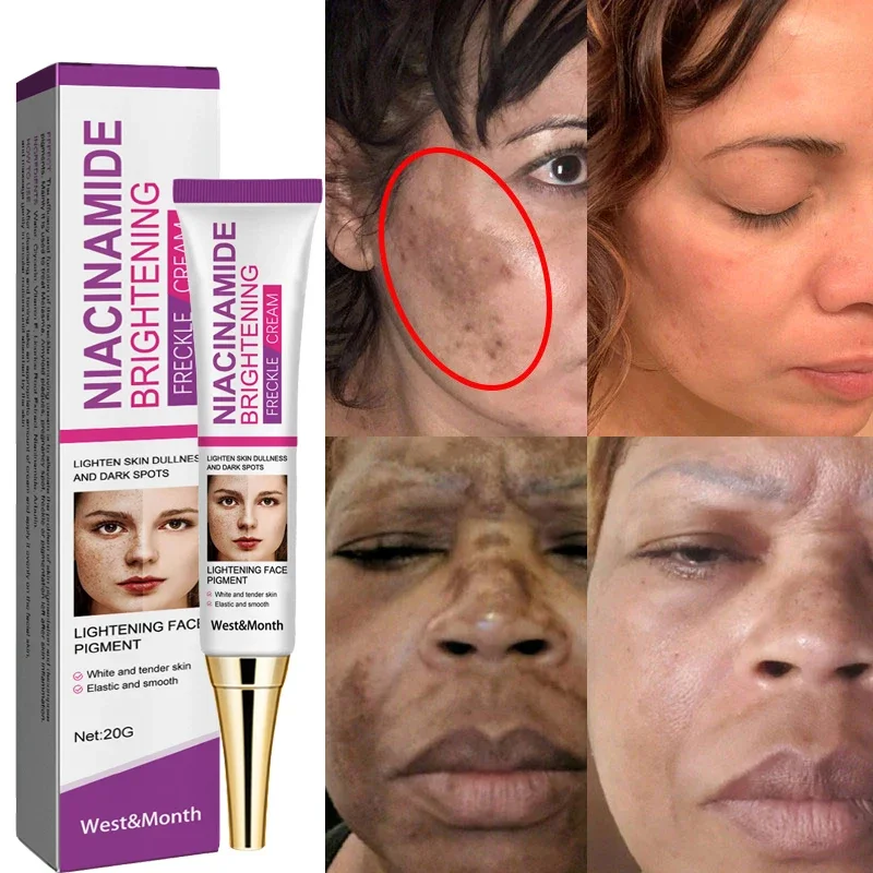 Nicotinamide Whitening Freckle Removing Cream Effectively Remove Melasma Dark Spot Acne Marks Lightening Melanin Face Skin Care 60pcs coconut milk essences whitening firming eye mask eye patch to remove dark circles fine lines staying up late skin care