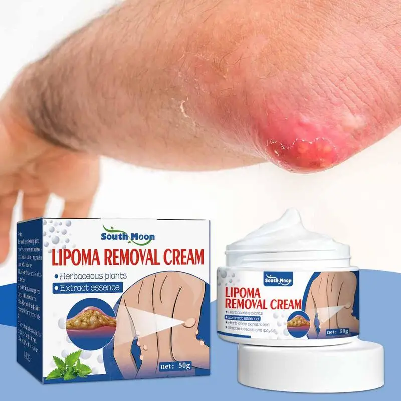 Lipoma Removal Cream The Whole Body Multiple Subcutaneous Conditioning Cream Eliminate Paste Fiber Paste Skin Care 50g