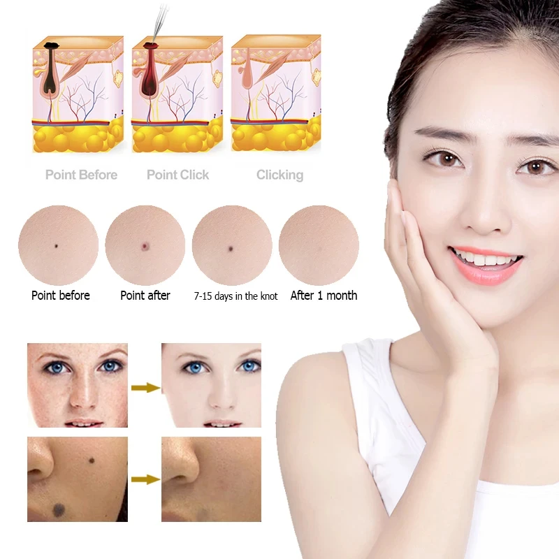 Plasma Pen Professional Laser Tattoo Mole Removal Pen Freckles Black Spots Papilloma Warts Moles Acne Tattoo Removal Skin Care.v