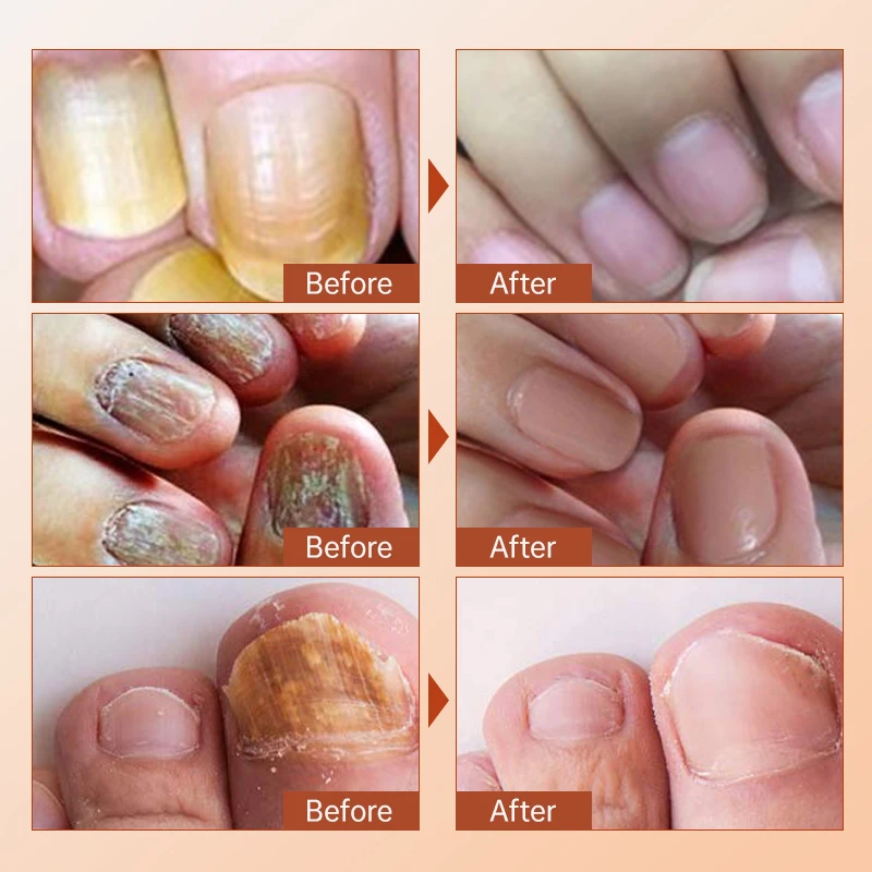 Toe Polish For Nail Fungus