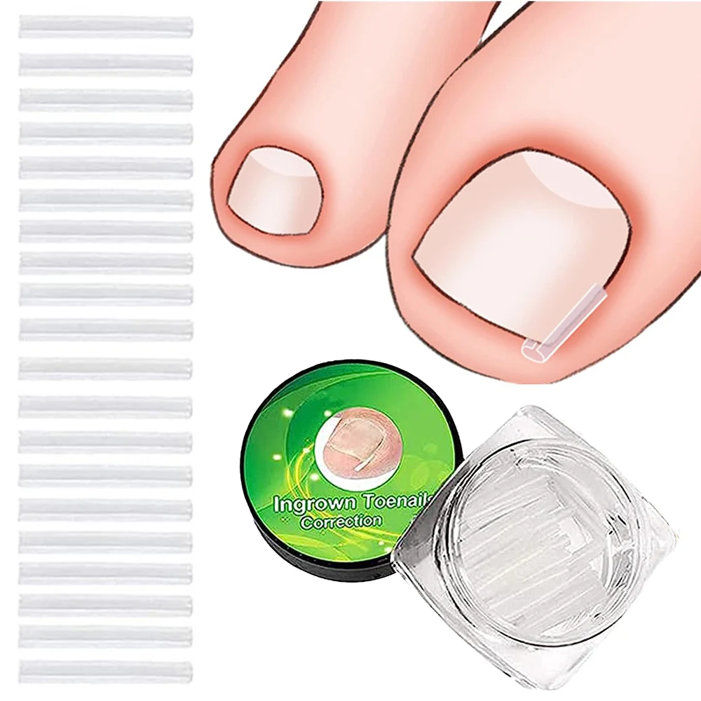 

10pcs Ingrown Toenail Corrector Strips Toenail Correction Patches Curved Toenails Straightening Recover Clips Pedicure Tools