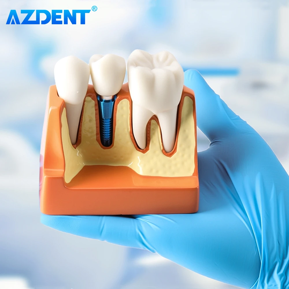 AZDENT 치과 4 배 치아 모델 임플란트 분석 크라운 브리지 데모 이동식 치과 연구 훈련 교육 모델