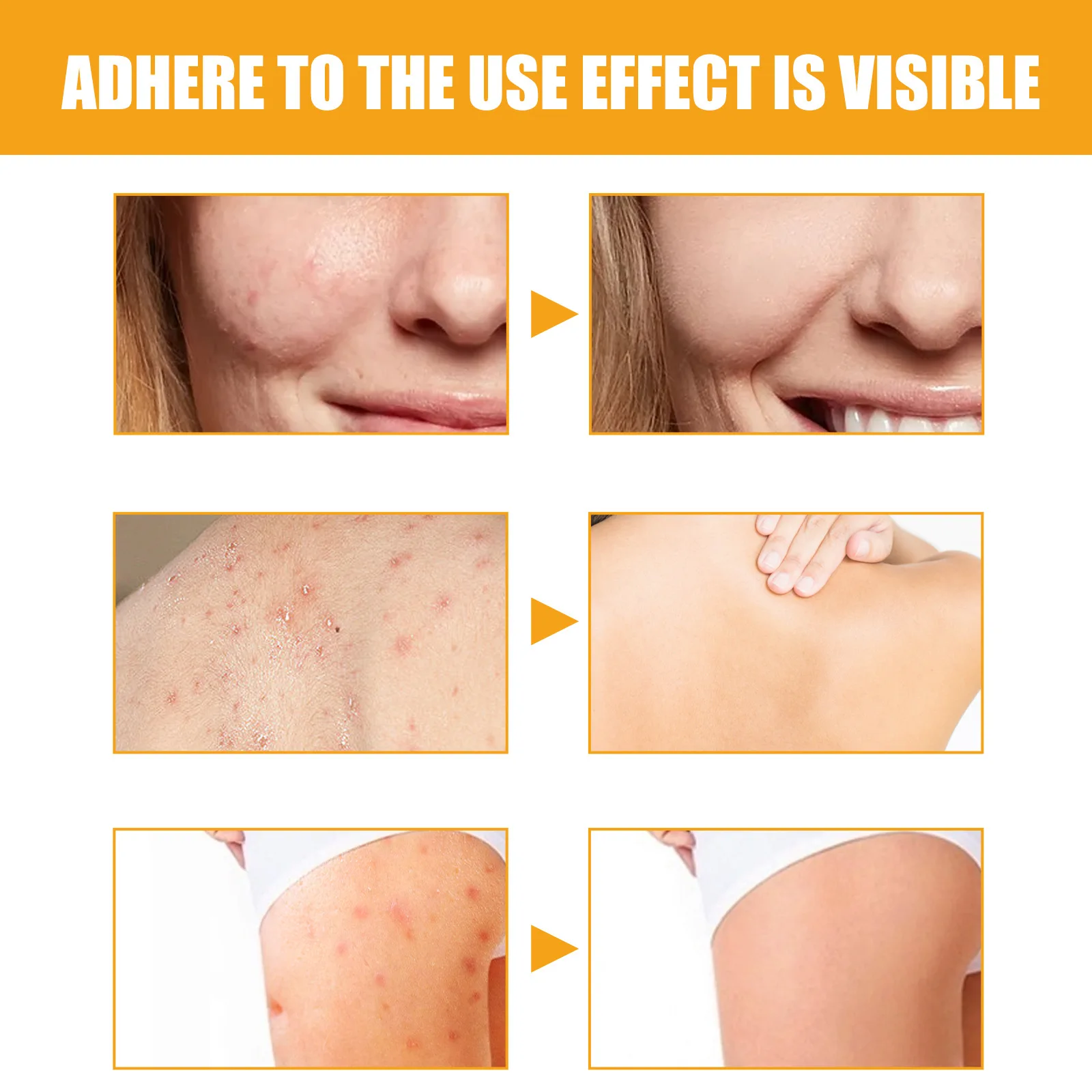 Рисунок 5 - Сыворотка для лечения акне для тела