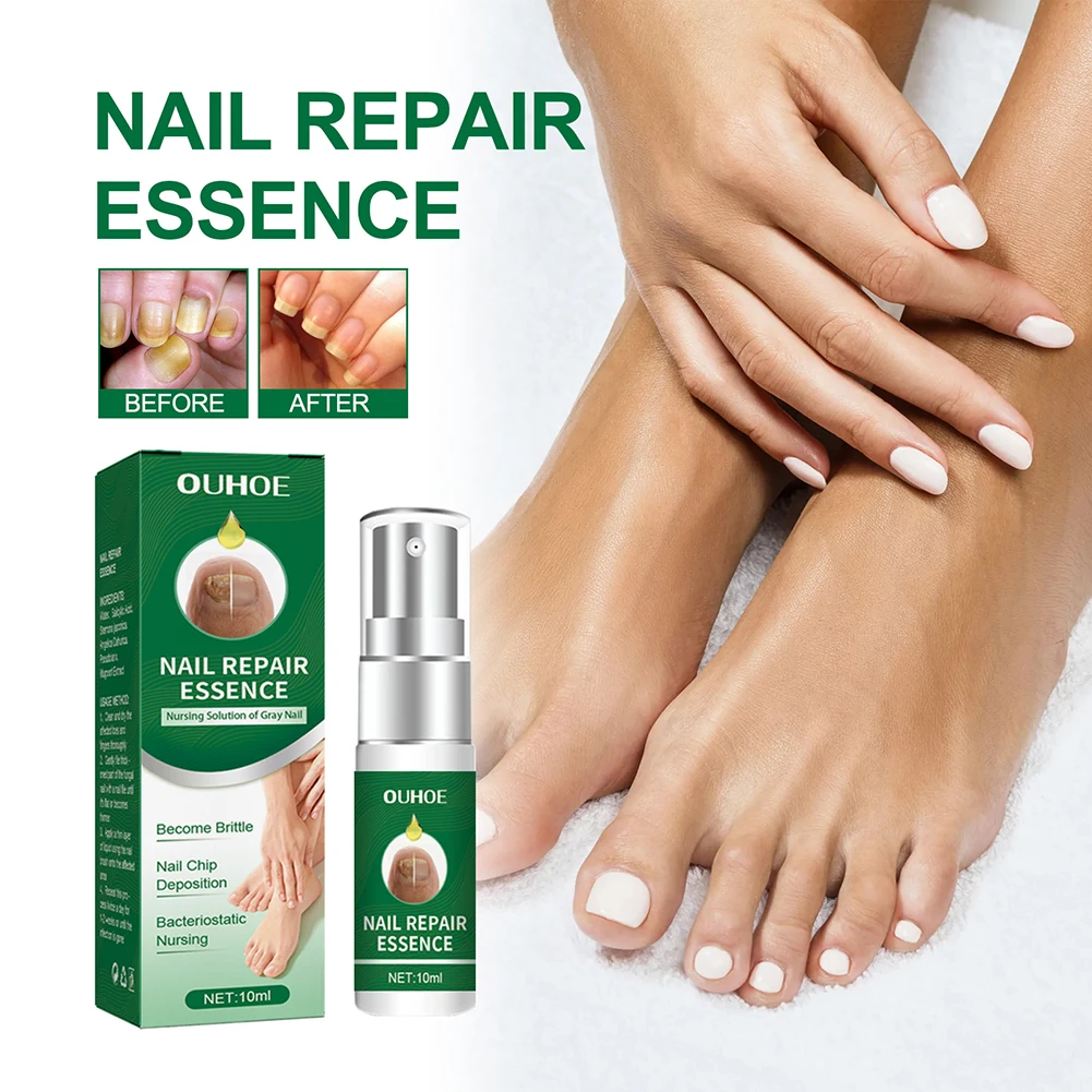 Toe Repair Nail Fungal Removal Gel Anti infective Paronychia