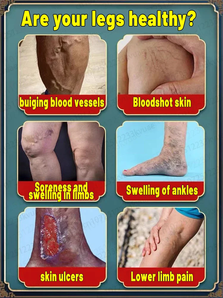 Varicose vein ointment, repair varicose veins and vasculitis in 7 days
