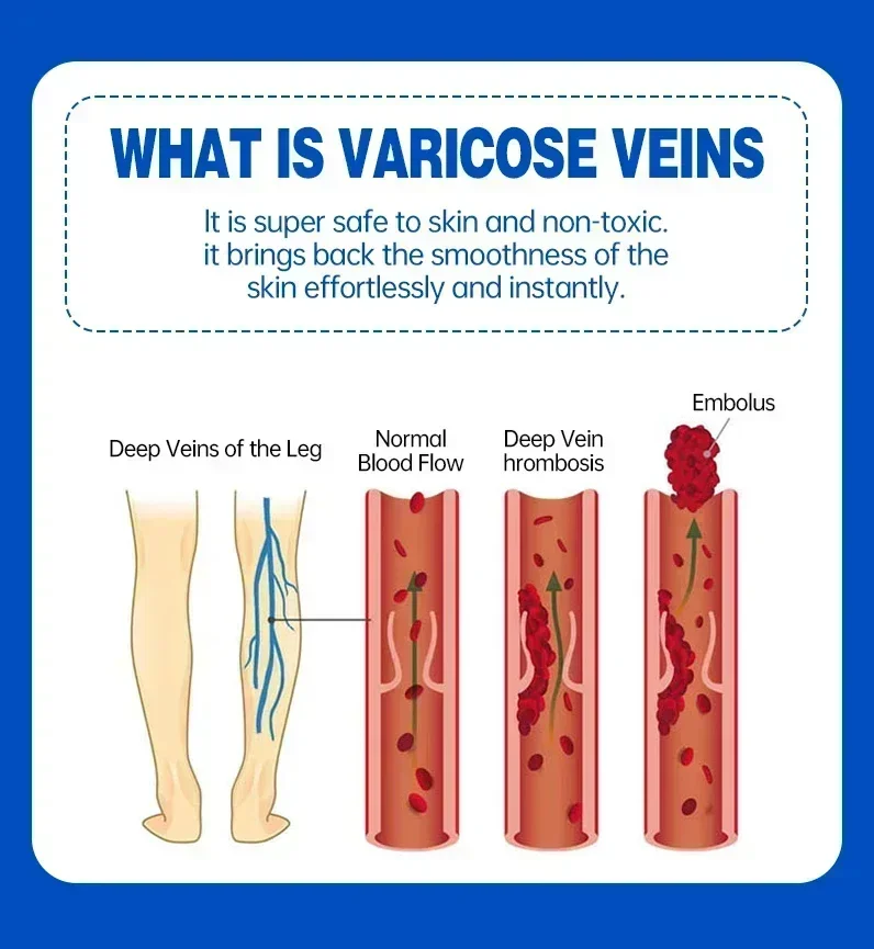 Varicose Vein Repair Cream Relieves Leg Bulge Pain Treatment Vasculitis Phlebitis