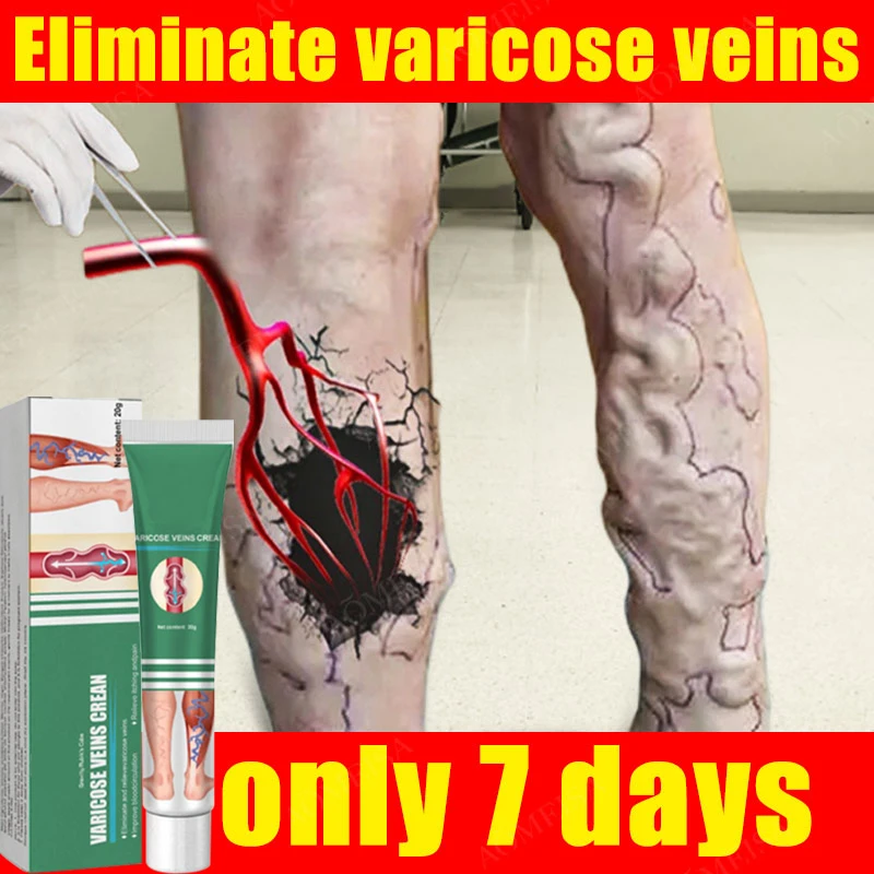 

Effective Varicose Vein Relief Cream Ointment For Varicose Veins To Relieve Vasculitis Phlebitis Spider Pain Treatment