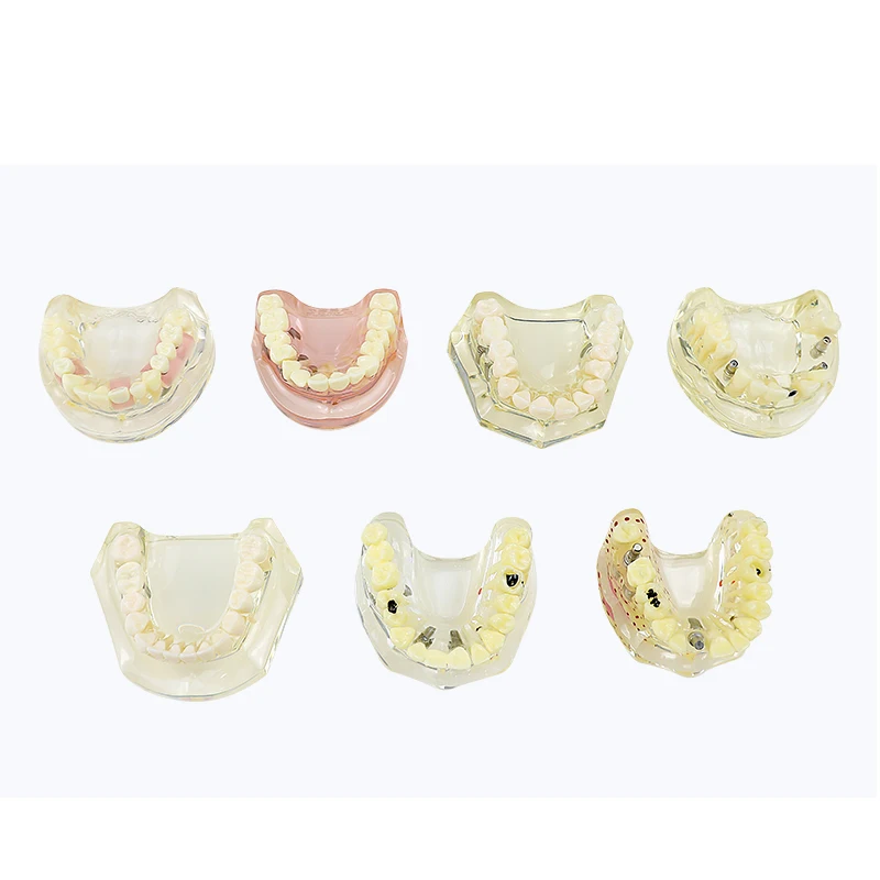 

Dental Materials Dental Caries Implant Model Teeth Model with Bridge Crown and Implant Bridge