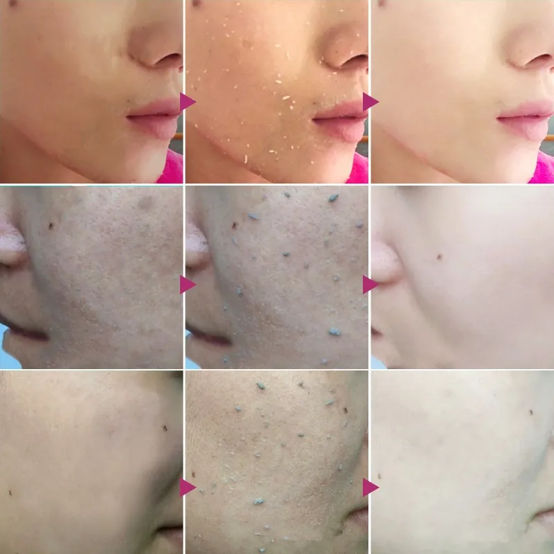Hydrolyzed Rice Face Exfoliating Cream Whitening Moisturizer Repair Facial Scrub Cleaner Acne Blackhead Treatment Remove Cream