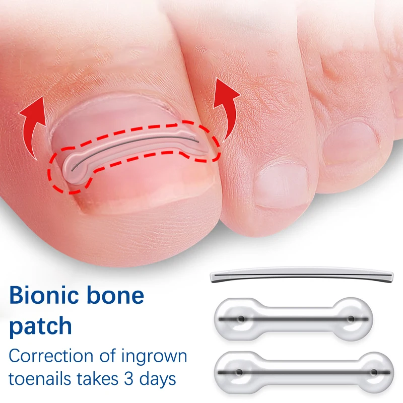 Ingrown Toenail Correction Tool Ingrown Toe Nail Treatment Elastic Patch Sticker Straightening Clip Brace Pedicure Tool 2Pcs