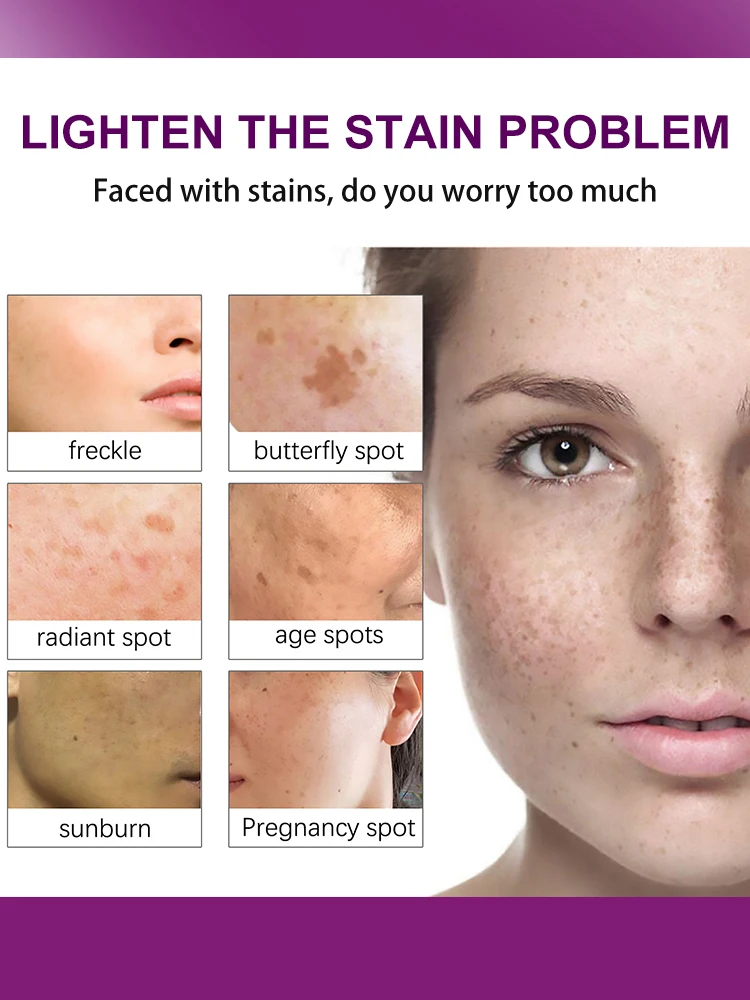 

Whitening Freckle Cream Remove Dark Spot