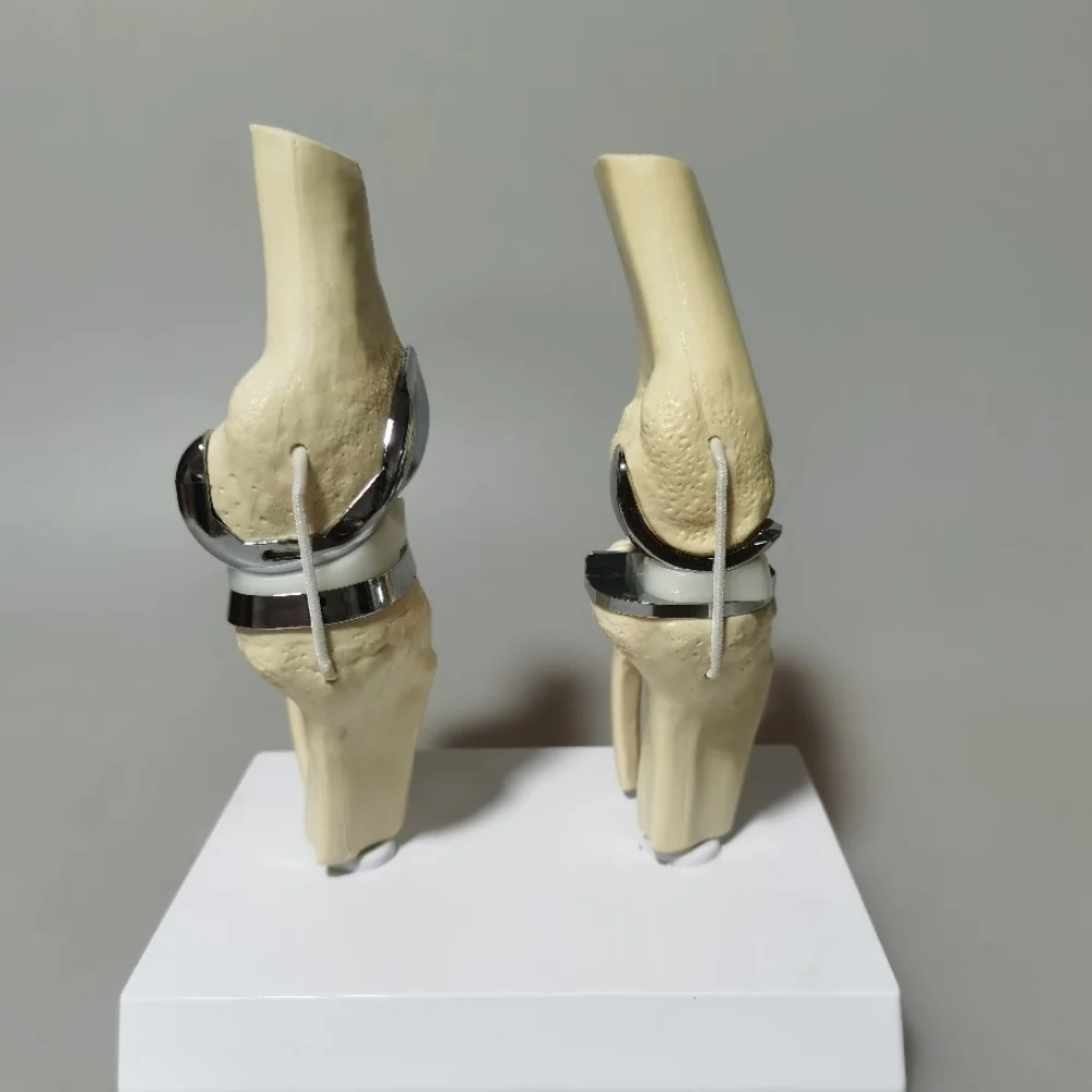 Detachable Artificial Knee Prosthesis Model Small Double Silver Knee Joint Implant Model Set