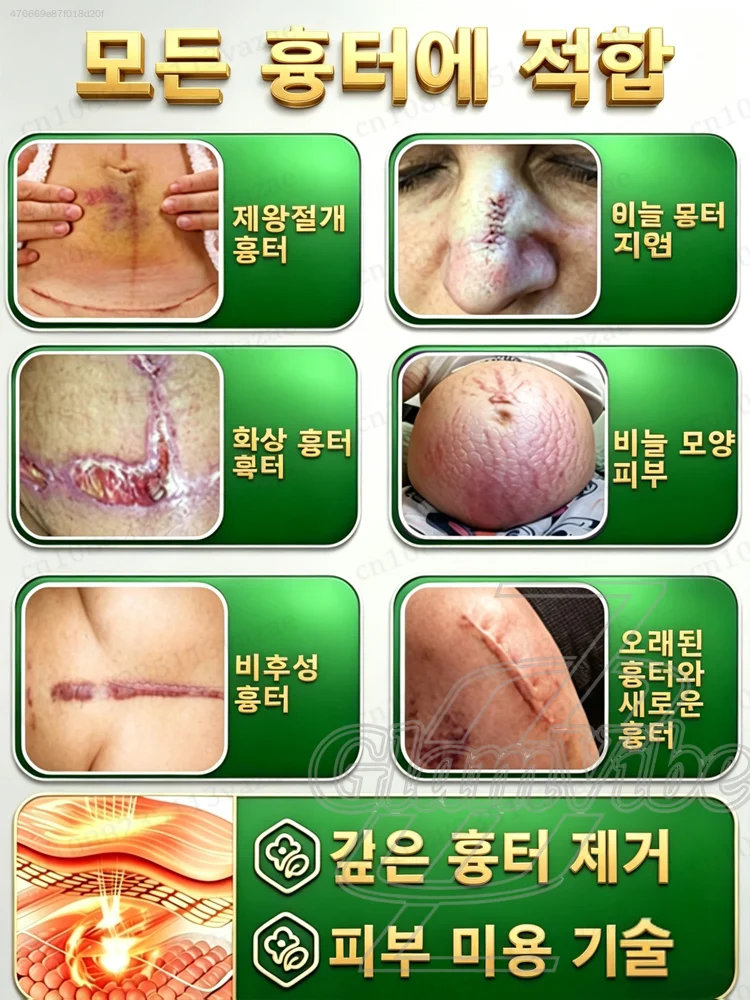 100% 흉터 제거 - 비후성 흉터, 화상 흉터 - 하나의 튜브로 모든 것을 해결합니다.+9659+794+