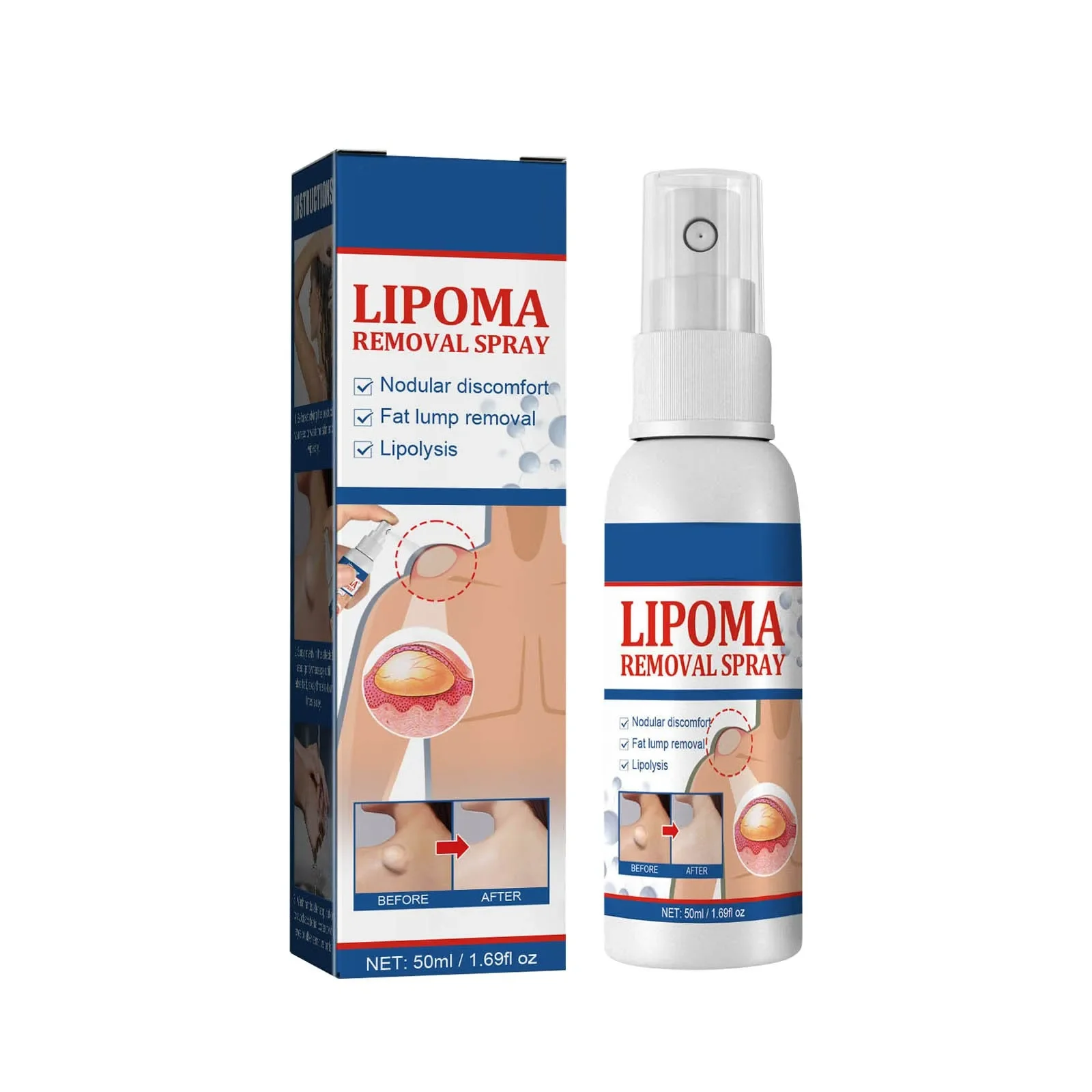 Fat knot Spray Relieves Body Lump Subcutaneous Nodule Dredging Spray Anti Tumor Mitigation Skin Swelling Pain Painless Treatment