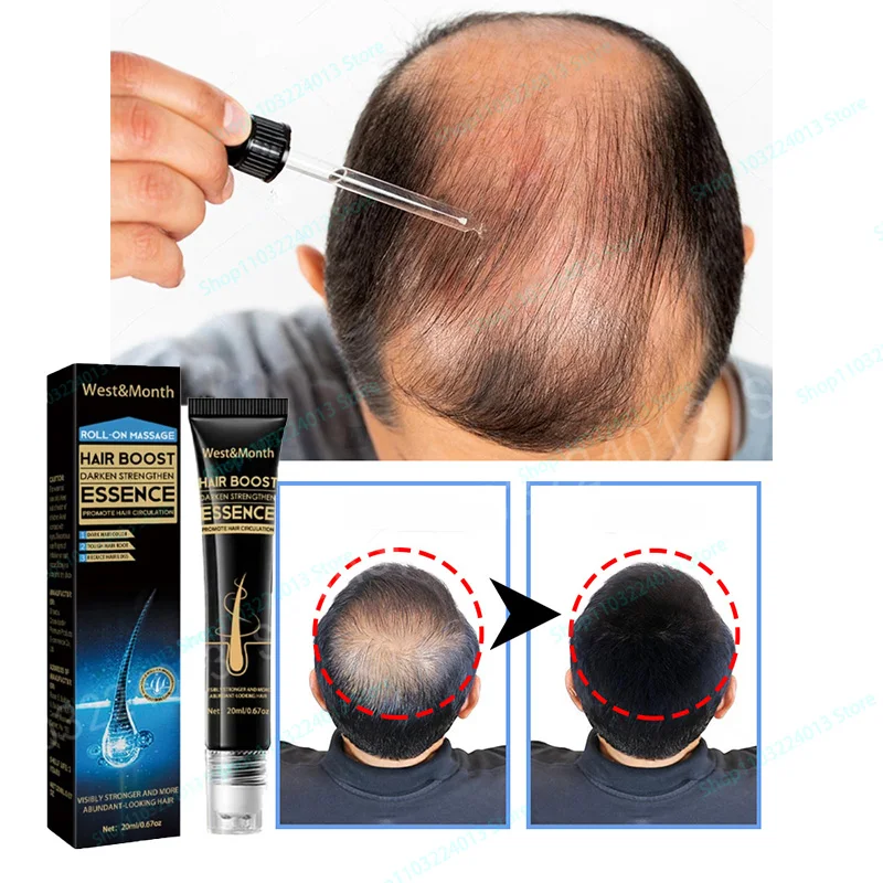 

Unisex Hair Growth Oil Hair Loss Treatment Rapid Hair Growth Effective Baldness Repair Hereditary Postpartum Hair Loss