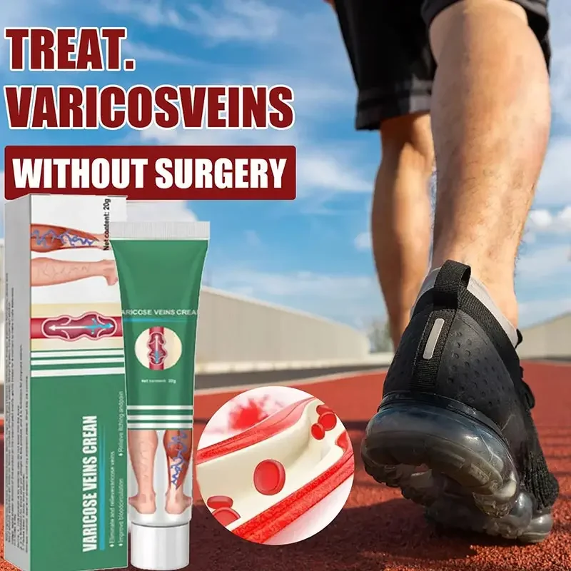 spider pain treatment ointment for varicose veins Effective varicose vein relief cream to relieve vasculitis phlebitis