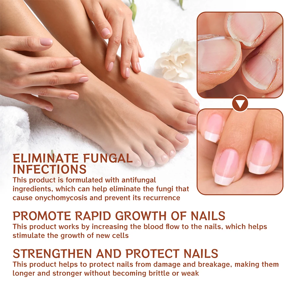 Nail Fungus Treatment Serum Toe Fungal Repair Products Hand Foot Care Removal Gel Anti Infection Onychomycosis Paronychia nail fungus remover