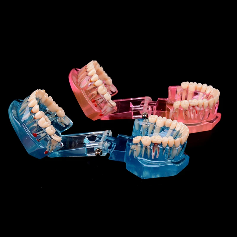 Hot Sale Dental Implant Disease Teeth Model for Medical Teaching Oral Health Care Science Dental Disease Teaching Study images - 6