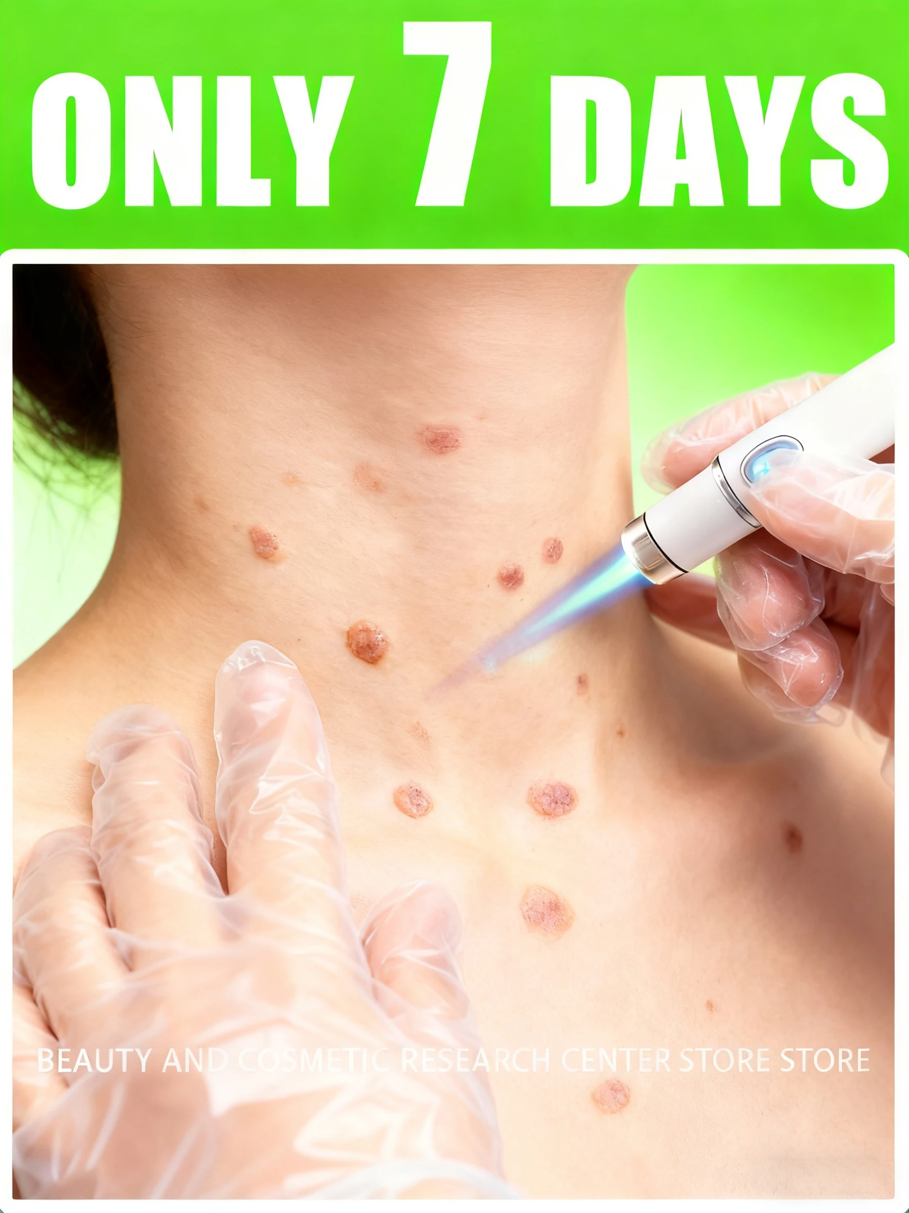 2025 Nouvelle génération de pointeur laser verrues améliorées réparation de racine de verrues