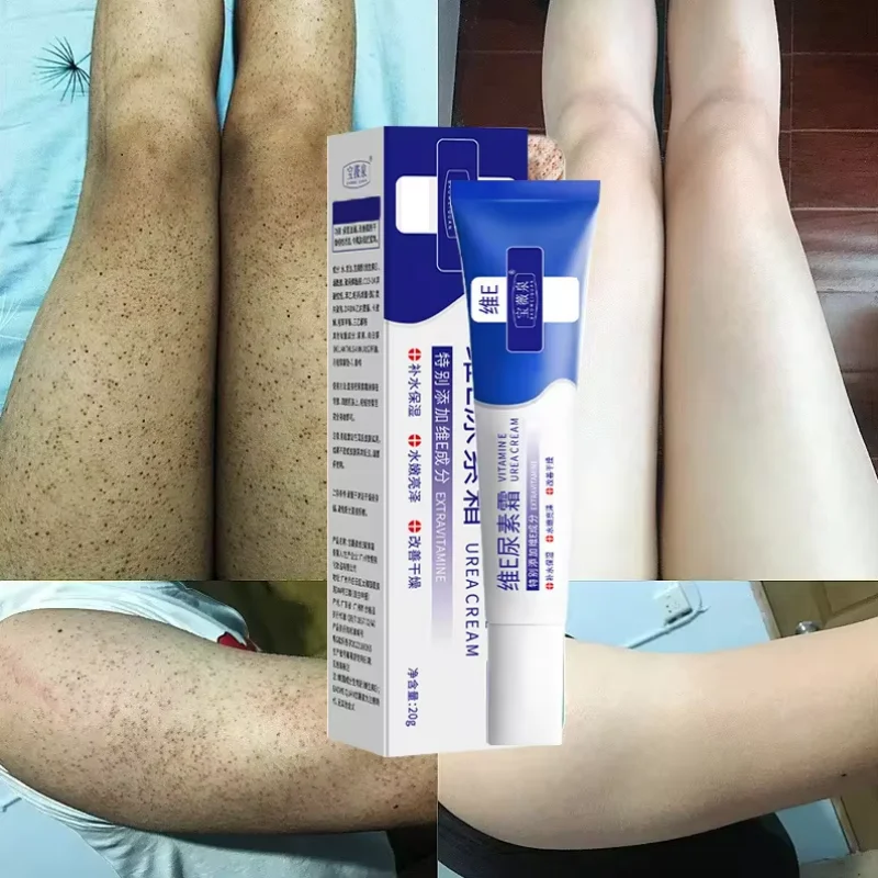 Curing Keratosis Pilaris Chicken Follicle Skin Repair Cream Body Dark Spot Remove Whiten Smooth Moisturize Skincare Body Lotion whitening body cream whitening cream body lotion brightening cream body care brightening body cream body skin care cream