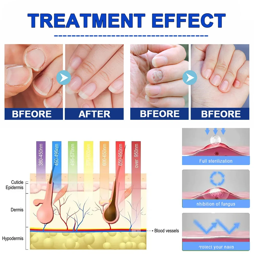 Nail Fungus Treatment Device Foot Toe Nails Fungal Repair Serum Anti Infection Gray Nails Onychomycosis Paronychia Remove Tools 5
