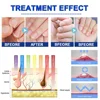 Nail Fungus Treatment Device Foot Toe Nails Fungal Repair Serum Anti Infection Gray Nails Onychomycosis Paronychia Remove Tools 5