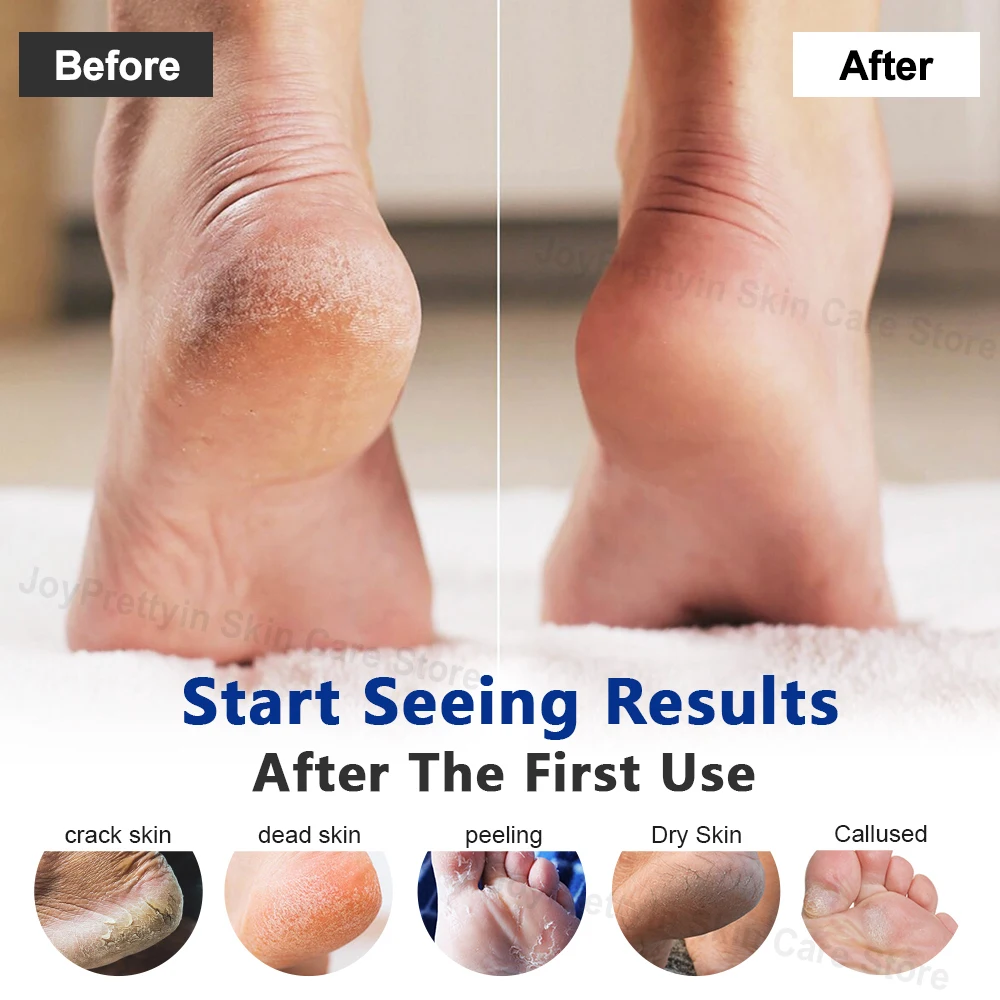 Foot Cream 42% Urea Coconut Oil for Feet & Hand Skin Care