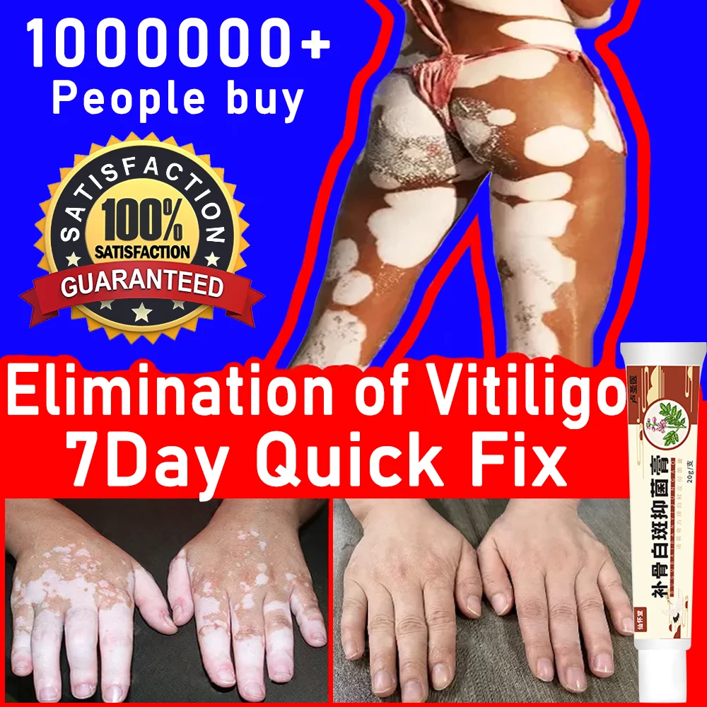 

Vitiligo Repair Cream Get Rid Of Ringworm White Spots Get Rid Of Skin Vitiligo Eliminate Vitiligo Better Body Skin