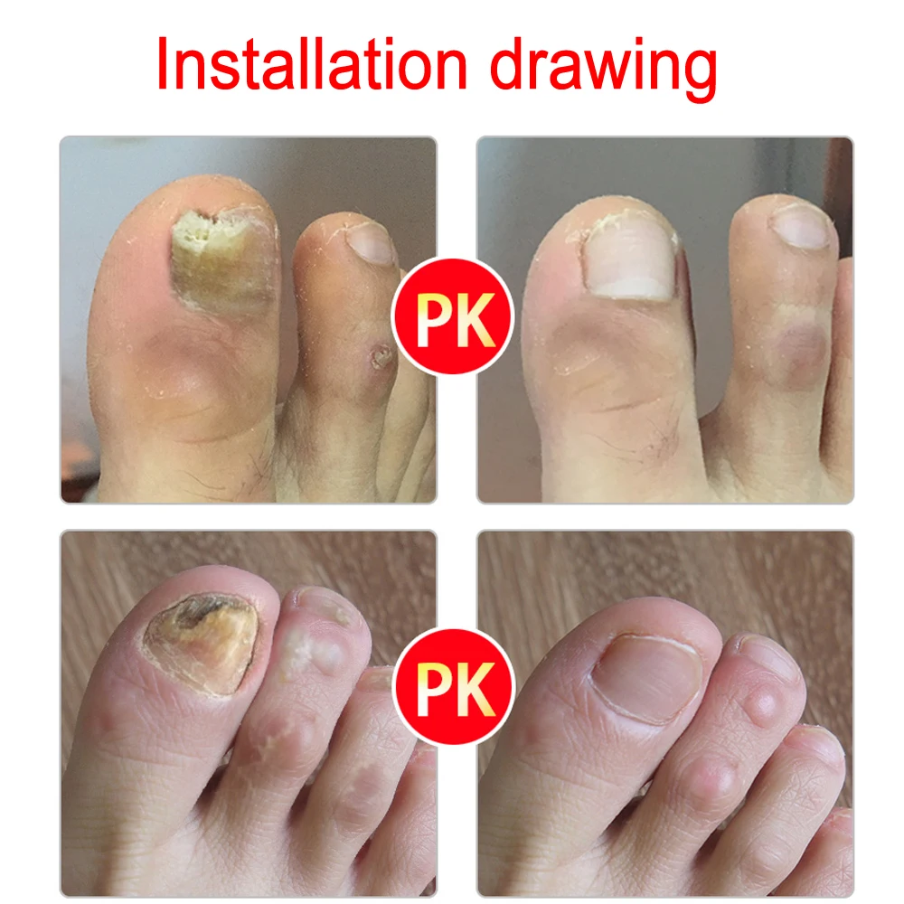 Nail Fungus Remover Anti Infection Fungal Nail Treatment Liquid Gel